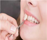 استشاري يكشف فوائد تركيب «فينير الأسنان»