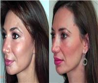استشاري تجميل يوضح مميزات حقن الدهون لعلاج تجاعيد الوجه