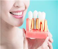  طبيب استشاري يوضح عوامل نجاح زراعة الأسنان