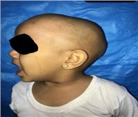 مستشفى سوهاج الجامعي تجري جراحة بمخ طفل لحمايته من فقدان البصر