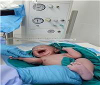 «عزل إسنا» يشهد إجراء الولادة القيصرية الـ12 لمصابة بـ«كورونا»