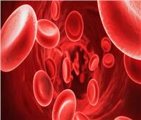 بحث جديد عن "فقر الدم المنجلي" لمن يعانون من زيادة نسبة الحديد في الدم