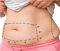 استشاري: شفط الدهون بالليزر يساعد في الوصول إلي جسم رشيق وقوام متناسق 