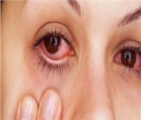روشتة وقائية للتخلص من أمراض العين في فصل الخريف 