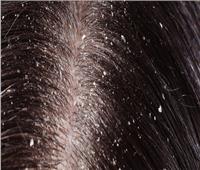 كيف تتخلصين من قشرة الشعر بعناصر «طبيعية» ؟