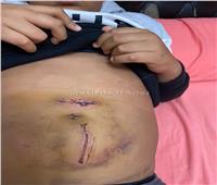 والد ضحية هجوم الكلاب: "ابني خد 5 غرز في البطن"