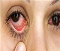 6 نصائح لعلاج «جفاف العين»..تعرف عليها 