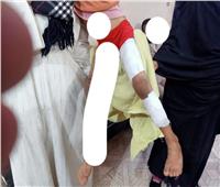 عامل يعذب طفلته بالحرق بجريد النخل في قنا