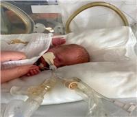 معجزة عيد الميلاد ..«أصغر طفل في العالم » يعود إلى الحياة 
