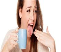 3 طرق طبيعية للتخلص من احتراق اللسان