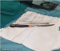 فريق مستشفى المنصورة ينقذ حياة شابا ابتلع سكينًا في مشاجرة 
