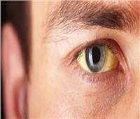 5 أسباب لاصفرار العين.. أبرزها فقدان الوزن 