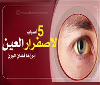 إنفوجراف| 5 أسباب لإصفرار العين.. أبرزها فقدان الوزن