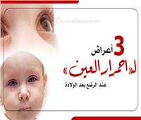 إنفوجراف| 3 أسباب لـ«احمرار العين» عند الرضع بعد الولادة