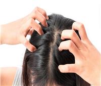 3 علاجات طبيعية لـ«حكة الشعر».. تعرَّف عليها