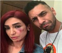 إصابة روجينا بجرح عميق في الوجه خلال تصوير «بنت السلطان»
