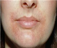 نصائح للسيطرة على التهاب الجلد حول الفم