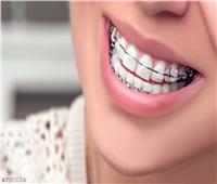 أضرار تقويم الأسنان ومخاطر استخدامه