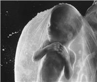 طفل بالمنوفية «حامل» في جنين.. له أظافر وشعر!!
