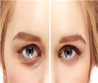 علاج سحري للعيون المنتفخة