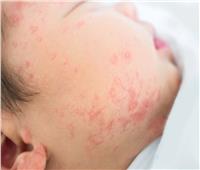 علاج الطفح الجلدي عند الأطفال بعد الإصابة بالحرارة 