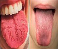 الصحة: 3 مليارات شخص حول العالم يصابون بأمراض الفم