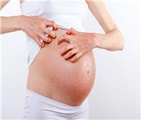 الطفح الجلدي أثناء الحمل.. تعرفي على أسبابه وطرق علاجه