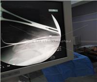 نجاح أول عملية تثبيت «خلع مفصل الكتف» بتقنية جديدة بمستشفى دكرنس العام