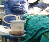 أطباء مستشفى الدلنجات ينجحون في استئصال الزائدة الدودية من شاب في العقد الثالث من العمر 