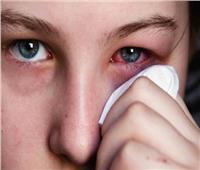 نصائح هامة لتجنب حدوث أي التهابات بالعين بسبب العدسات اللاصقة