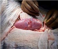 خالد منتصر: جراحة زرع كلى الخنزير في الإنسان تفيد مرضى السرطان