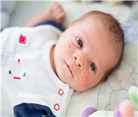 أسباب الحبوب الجلدية لدى الرضع.. وطرق الوقاية منها