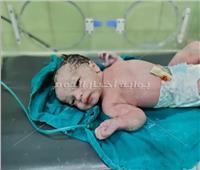 إجراء عمليتي ولادة قيصرية لمصابتين بكورونا في غرفة عمليات واحدة بالبحيرة