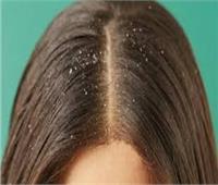 5 وصفات طبيعية لعلاج قشرة الشعر بالمنزل