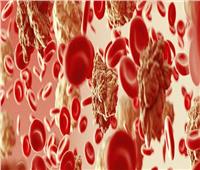 دراسة| اكتشاف نوع جديد من العلاج قد يقضي على سرطان الدم