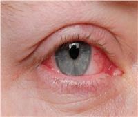 خبراء: العيون الوردية علامة خفية تحذر من الأصابة بكورونا
