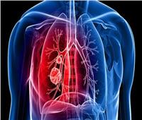 مكمل «بيتا كاروتين» قد يزيد من فرص الإصابة بسرطان الرئة