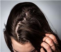 للجنس الناعم| العلاجات الطبيعية البسيطة للمساعدة في محاربة الشعر الدهني