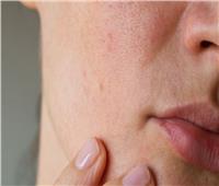 9 علامات في بشرتك تسببها أمراض الكلى.. أبرزها جفاف البشرة والحكة 
