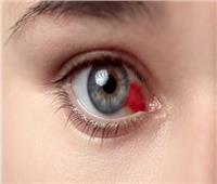 أسباب ظهور البقع الحمراء في العين بشكل مفاجئ