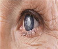 أستاذ عيون: المياه الزرقاء مرض وراثي وتؤدى إلى عدم الرؤية