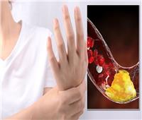3 أعراض على يديك تنذر بخطر ارتفاع نسبة الكوليسترول في الدم
