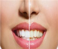 أسنان صفراء .. 5 علاجات منزلية فعالة وسهلة لجعلها بيضاء
