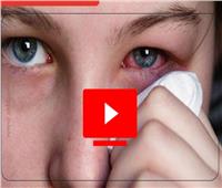   فيديوجراف| نصائح للوقاية من أمراض العيون في الصيف 
