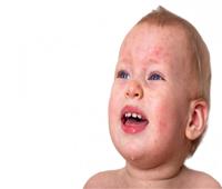  تهديد جديد.. «متلازمة الخد الصفعية» مرض يصيب الأطفال ..تعرف علي أعراضه