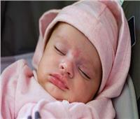 للأطفال .. علاج البقع الغامقة «المنغولية» عند الطفل