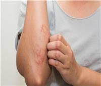 أسباب التهاب الجلد الفيروسي وطرق علاجه