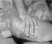 الصحة العالمية: أول إصابة بشرية بجدري القرود1970.. حدثت لصبي 9 سنوات