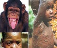 «الصحة العالمية» تعلن مراحل تطور أعراض الإصابة بـ«جدرى القرود»