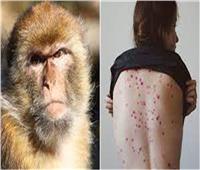 وزارة الصحة تصدر الدليل الإرشادي للتعامل مع مخالطين «جدرى القرود»  